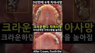 크라운 했다 치아사망, 결국 임플란트. 9년만에 6개 치아사망. 임플란트교합을 정상적으로 물리게 해야함. 지르코니아 보다 PFM 금니 추천.  임플란트06강 2025_06_20