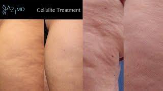 Cellulite