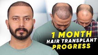 Hair Transplant in Kota | Best Results & Cost of Hair Transplant in Kota