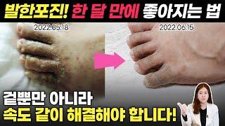 가려움과 통증을 유발하는 한포진! 연고만 바른다고 낫지 않습니다! 재발 없이 없애는 방법!  [ 위례해오름한의원 ]
