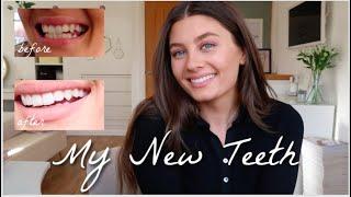 MY SMILE JOURNEY WITH SMILELIFE COMPLETED | BEFORE AND AFTER | Amy-Beth