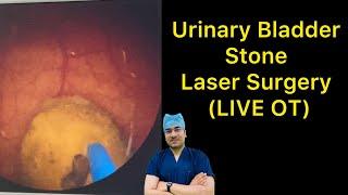 Urinary Bladder Stone Symptoms and Laser Treatment (LIVE SURGERY) Dr Deepanshu Gupta