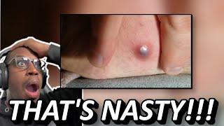 I HAVE NEVER SEEN BLACKHEADS THIS BIG BEFORE!  | Huge blackheads and pimples