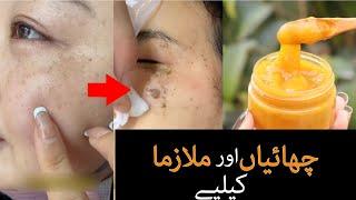 Melasma, freckles, pigmentation and hyper pigmentation remove in one month with this gel