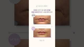 갑자기 생긴 입가 주름! 콜라겐 주사로 노화를 방지하세요!