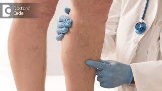 Duration of hospital stay and recovery time for DVT - Dr. Anand R Shenoy