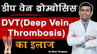 डीप वेन थ्रोम्बोसिस (डीवीटी)  | DVT Deep Vein Thrombosis | Dr.Sital Tongase |