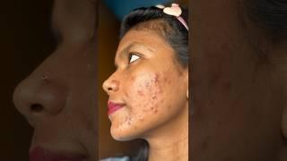 My skin transformation  video #shorts #acnetreatment #skincare #pimpleproblem #vi#tranding #beauty