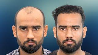 Hair Transplant In Surat || Hair Transplant Journey in Surat ||Cost Effective Clinic in Surat