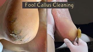 Callus Removal From Feet  Foot Callus Removal Satisfying