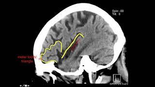 Introduction to Brain Surface Anatomy