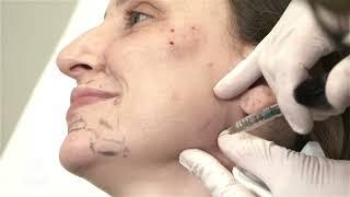 Full-face Rejuvenation and Beautification on a female patient | MAILI