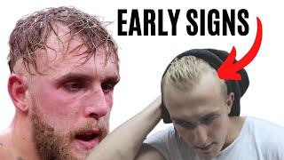 How Jake Paul Lost His Hair