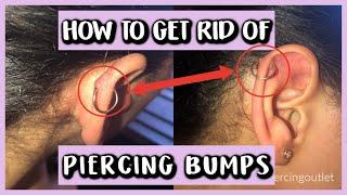 HOW TO GET RID OF PIERCING BUMPS