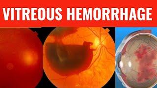 VITREOUS HEMORRHAGE || Everything you need to know