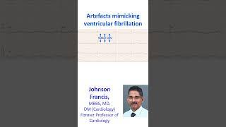 Artefacts mimicking ventricular fibrillation