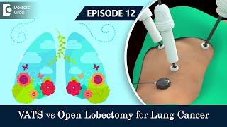 VATS Vs OPEN LOBECTOMY For Effective Lung Cancer Treatment | Dr.Sandeep Nayak &  Dr. Sreekanth Reddy