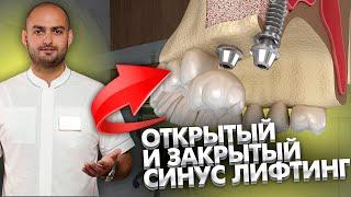 Открытый и закрытый синус-лифтинг в стоматологии, что это такое?