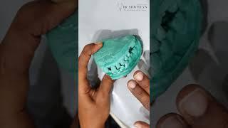 CASE SPOTLIGHT: Part 1 of a Smile Design Journey | Dr.Sowmya's Dental Care| Teynampet
