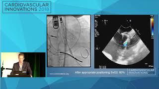 CVI2018 Session: My most humbling TAVR case - Alan Zajarias, MD