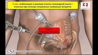 Рак толстой кишки: лечение рака операцией лапароскопическая резекция сигмовидной кишки