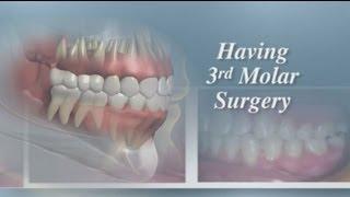 Having Third Molar Surgery