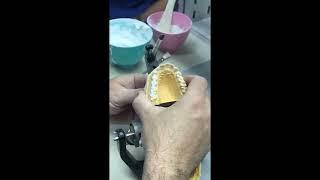 Flat occlusal splint