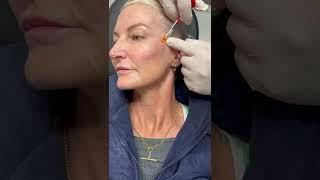 Cheek dermal filler l Newcastle Cosmetic Doctor l Procedure performed by cannula technique.