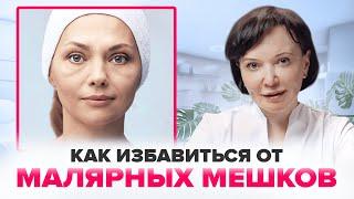 МАЛЯРНЫЕ МЕШКИ. Как избавиться от малярных мешков под глазами без операции | Ирина Рахова