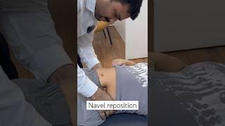 Navel reposition treatment | navel displacement treatment #trending  #shortfeed #trend