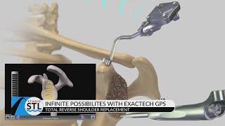 Exactech Shoulder Replacement option from Signature Orthopedics Group