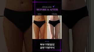 복부 지방흡입 &  골반 지방이식 #허파고리