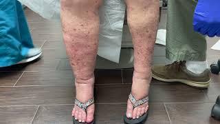 Blood Clot Causing Leg Swelling: Dr. Bush Explains the Reason