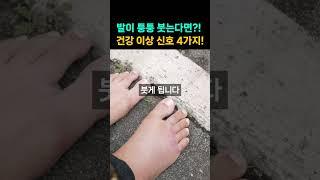 발이 퉁퉁 붓는다면?! 부종의 원인, 건강 이상 신호 4가지!   #건강정보 #건강