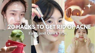 20 hacks to get rid of Pimples and Acne marks ️ / Ultimate guide