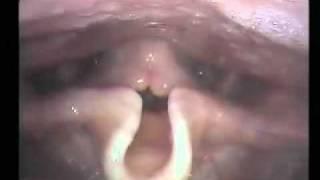 Laryngoscopy: Healthy male opera singer singing