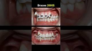 2000$ for this braces case #dentist #orthodontist #braces