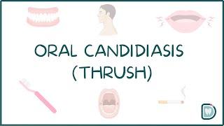 Understanding Oral Candidiasis or Oral Thrush