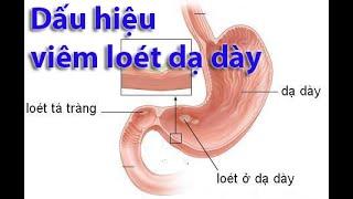 Dấu hiệu bệnh viêm loét dạ dày