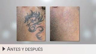 Eliminar tatuajes con láser - Antes y después