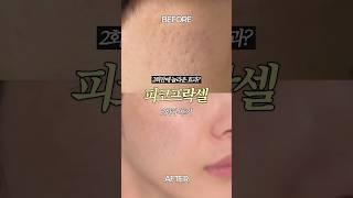 피코프락셀 2회차 후기: 여드름 흉터 & 모공 개선 효과 있었을까?