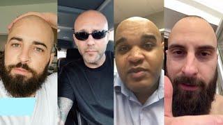 BALD MEN Tell You How They Accepted Their Hair-loss And Went Bald