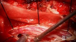 Live Surgery: Resection of Spinal Tumor - Rod J. Oskouian, M.D.