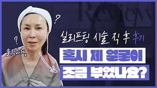50대 중반 실리프팅 시술 직후! 생생한 솔직한 후기