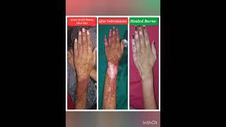 Acute Scald Burns on Hand with Hot Oil - Patient Testimonial