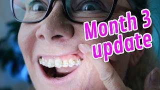 Month 3 Adult Braces Update MOVING TEETH!