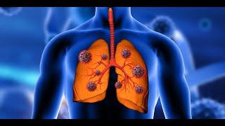 The Use of Ozone in the Pulmonary Obstructive Disease