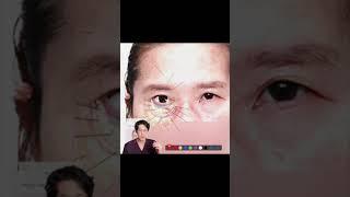 Ep7-3. 리프팅공부 레이저눈밑지 더이상 속지마세요 제2탄 / 유지인대의 중요성 ▶︎ #대구눈밑지방재배치 #레이저눈밑지방재배치 #앙코르 #대구이마거상 #대구성형외과