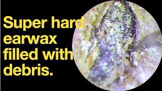 Super hard earwax filled with debris. |ear wax removal | ear cleaning | ASMR | relaxation | relax