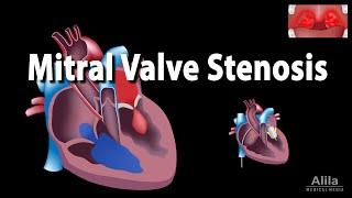 Mitral Valve Stenosis, Animation